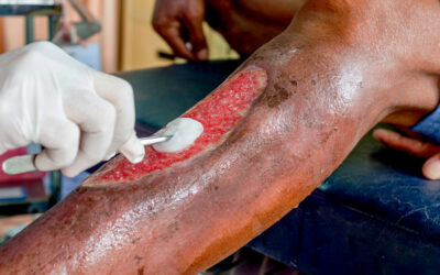 Accelerate Wound Healing with Hyperbaric Oxygen Therapy