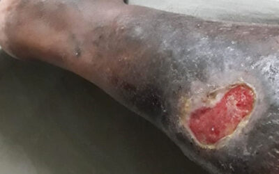 Chronic Wound Management in Aluva: How Hyperbaric Oxygen Therapy Helps